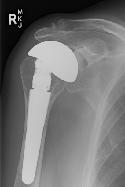 CTA Hemiarthroplasty